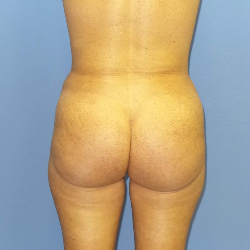 Brazilian Butt Lift Before & After Gallery - Patient 158798 - Image 4