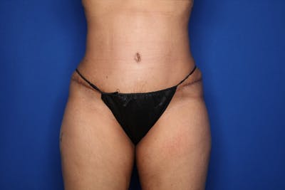 Tummy Tuck Before & After Gallery - Patient 383997 - Image 2