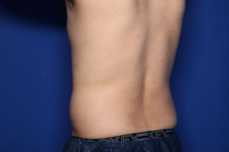 BodyTite™ Before & After Gallery - Patient 377139 - Image 3