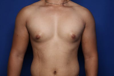 Gynecomastia (Male Breast Reduction) Before & After Gallery - Patient 404930 - Image 1