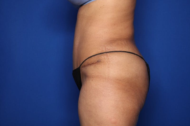 Tummy Tuck Before & After Gallery - Patient 383997 - Image 4