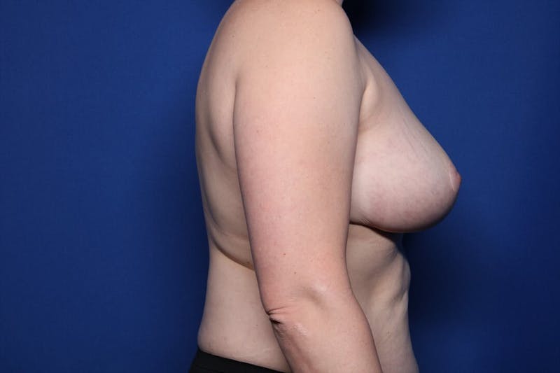 Breast Reduction Before & After Gallery - Patient 133491 - Image 4
