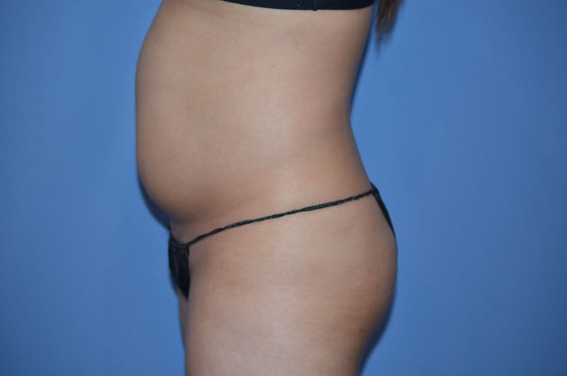 Liposuction Before & After Gallery - Patient 299821 - Image 3