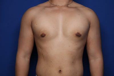 Gynecomastia (Male Breast Reduction) Before & After Gallery - Patient 404930 - Image 2