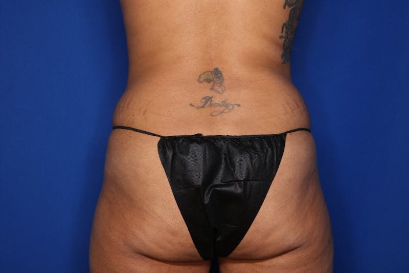 Tummy Tuck Before & After Gallery - Patient 383997 - Image 5