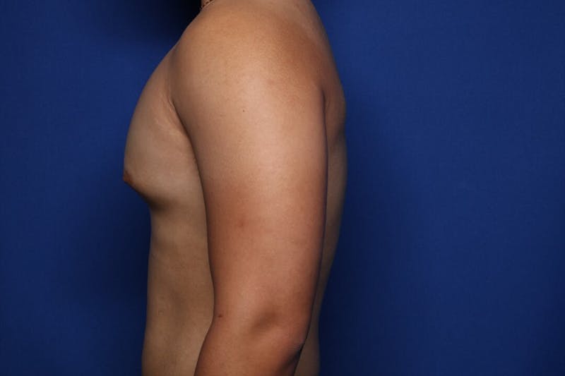 Gynecomastia (Male Breast Reduction) Before & After Gallery - Patient 404930 - Image 3