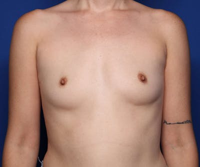 Breast Augmentation Before & After Gallery - Patient 112982 - Image 1