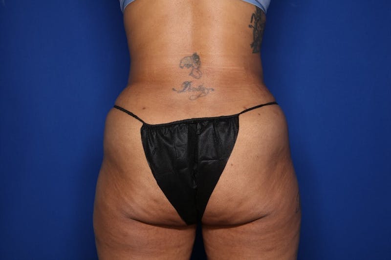 Tummy Tuck Before & After Gallery - Patient 383997 - Image 6