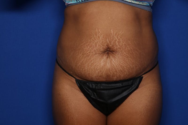 BodyTite™ Before and After Before & After Gallery - Patient 190890 - Image 1