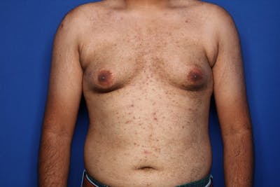 Gynecomastia (Male Breast Reduction) Before & After Gallery - Patient 298642 - Image 1