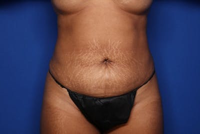 BodyTite Before & After Gallery - Patient 190890 - Image 2