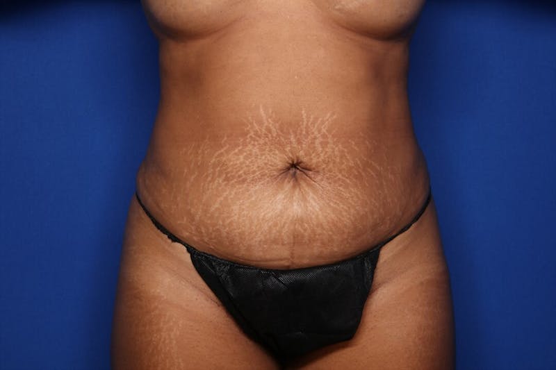 BodyTite™ Before & After Gallery - Patient 190890 - Image 2