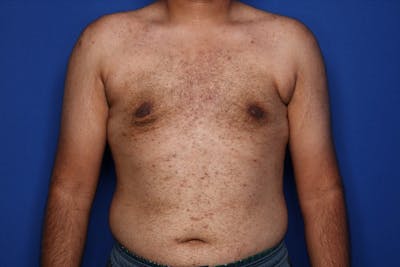 Gynecomastia (Male Breast Reduction) Before & After Gallery - Patient 298642 - Image 2