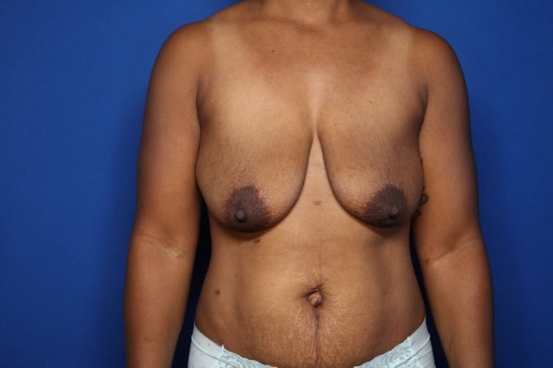 Breast Augmentation + Lift Before & After Gallery - Patient 724123 - Image 1