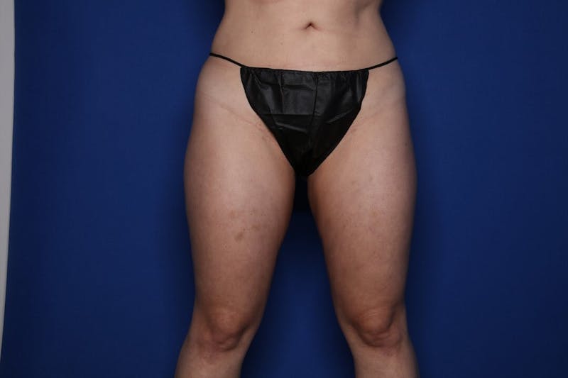 Liposuction Before & After Gallery - Patient 378149 - Image 2