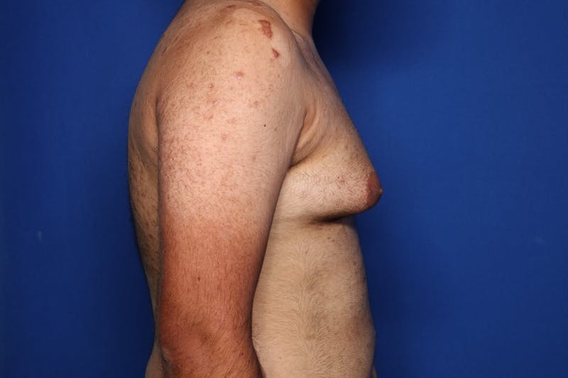 Gynecomastia (Male Breast Reduction) Before & After Gallery - Patient 298642 - Image 3