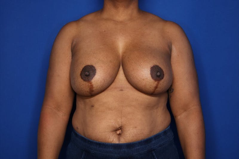 Breast Augmentation + Lift Before & After Gallery - Patient 724123 - Image 2