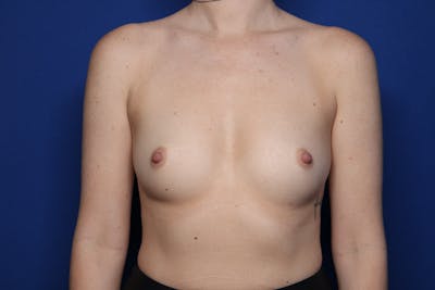 Breast Augmentation Before & After Gallery - Patient 436803 - Image 1