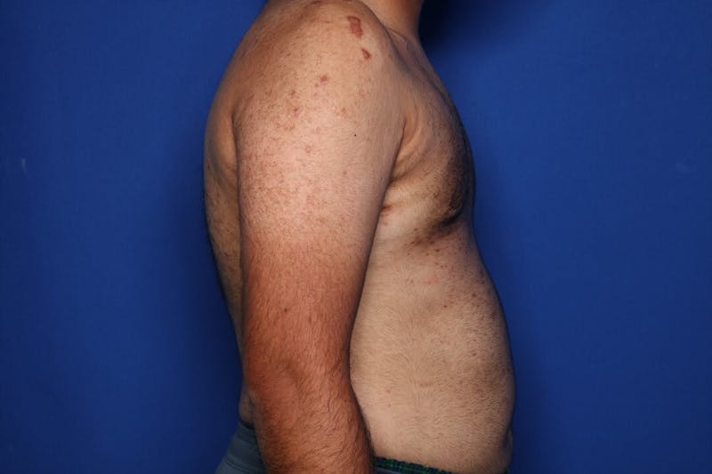 Gynecomastia (Male Breast Reduction) Before & After Gallery - Patient 298642 - Image 4
