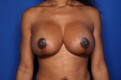 Breast Revision Before & After Gallery - Patient 360235 - Image 2