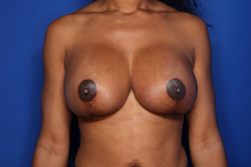 Breast Revision Before & After Gallery - Patient 360235 - Image 2