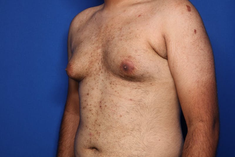 Gynecomastia (Male Breast Reduction) Before & After Gallery - Patient 298642 - Image 5