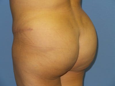 Brazilian Butt Lift Before & After Gallery - Patient 126387 - Image 2