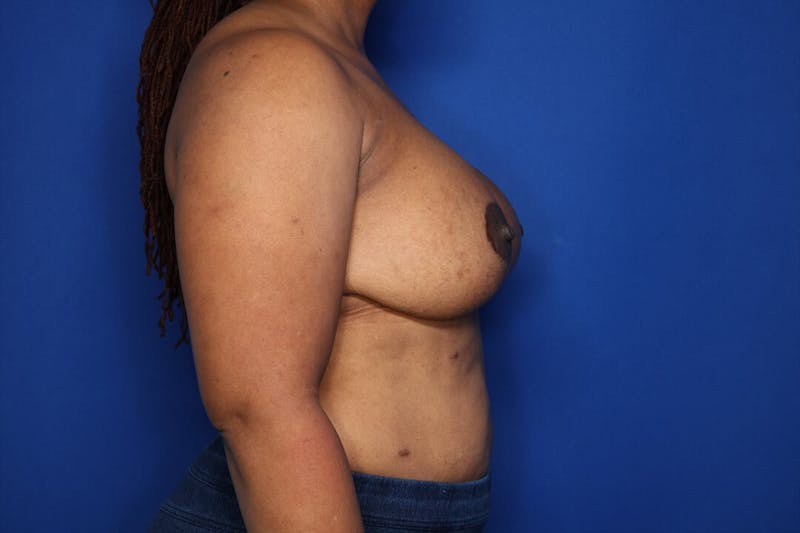 Breast Augmentation + Lift Before & After Gallery - Patient 724123 - Image 4