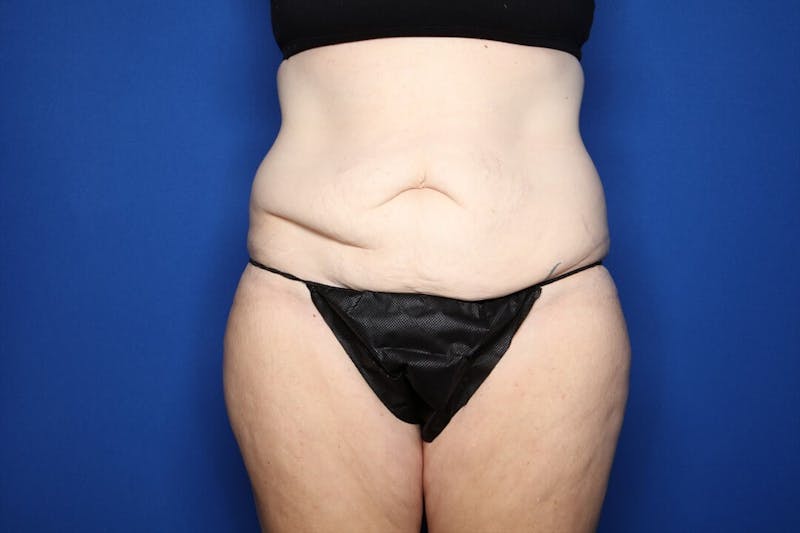 Tummy Tuck Before & After Gallery - Patient 236852 - Image 1