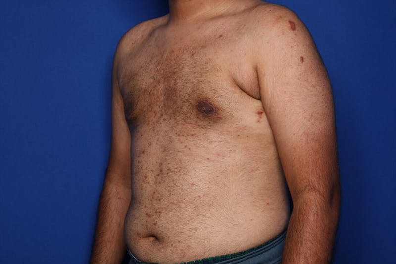 Gynecomastia (Male Breast Reduction) Before & After Gallery - Patient 298642 - Image 6