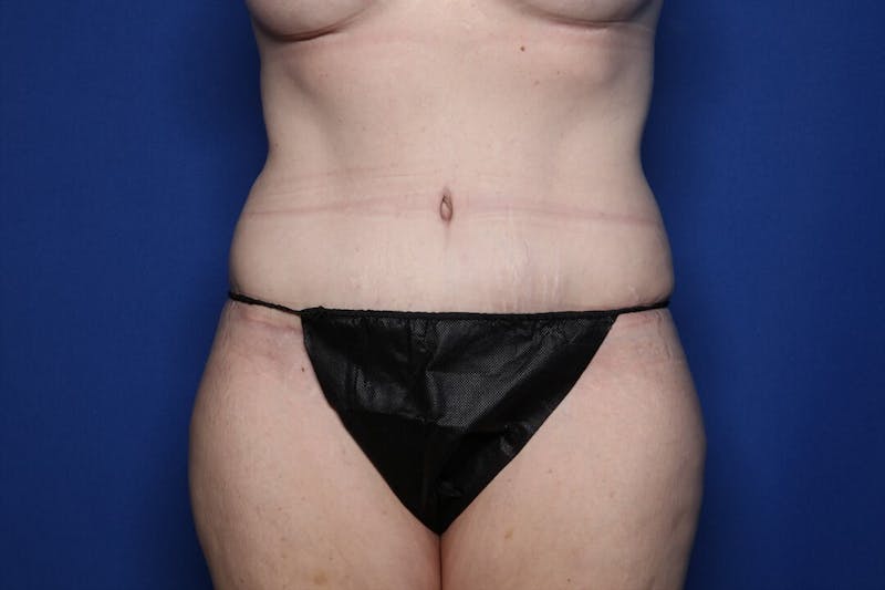 Tummy Tuck Before & After Gallery - Patient 236852 - Image 2