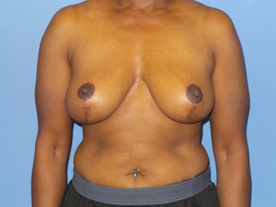 Breast Reduction Before & After Gallery - Patient 254654 - Image 2