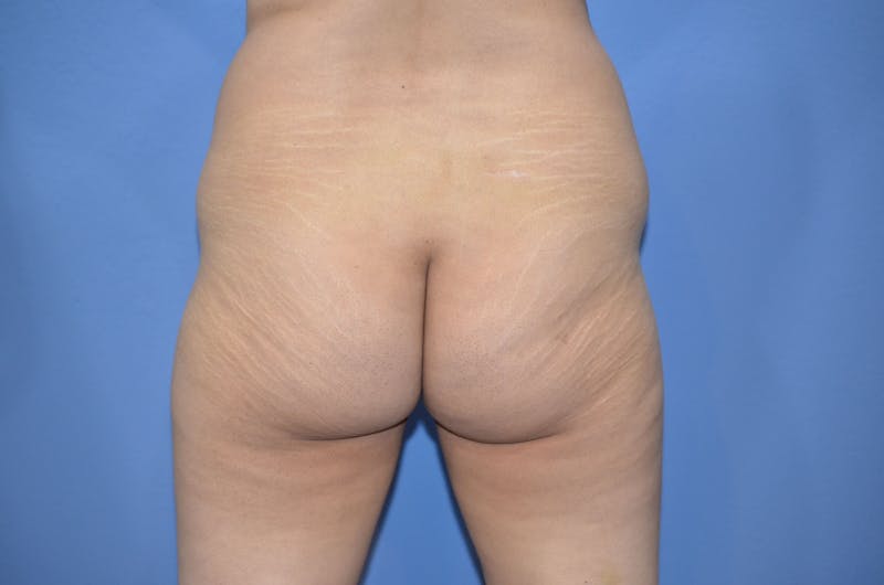 Brazilian Butt Lift Before & After Gallery - Patient 330451 - Image 3