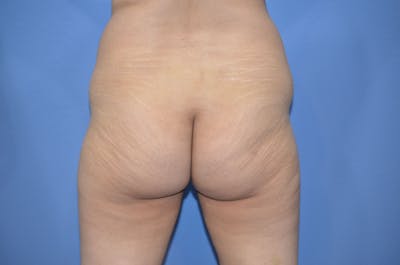 Brazilian Butt Lift Before & After Gallery - Patient 330451 - Image 1
