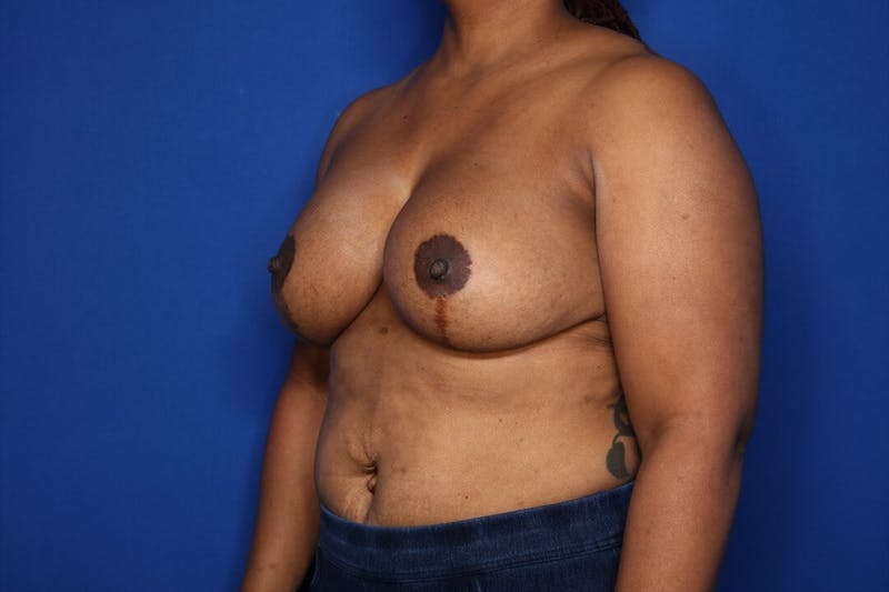 Breast Augmentation + Lift Before & After Gallery - Patient 724123 - Image 6