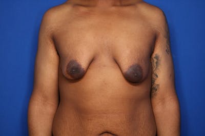 Gynecomastia (Male Breast Reduction) Before & After Gallery - Patient 207748 - Image 1