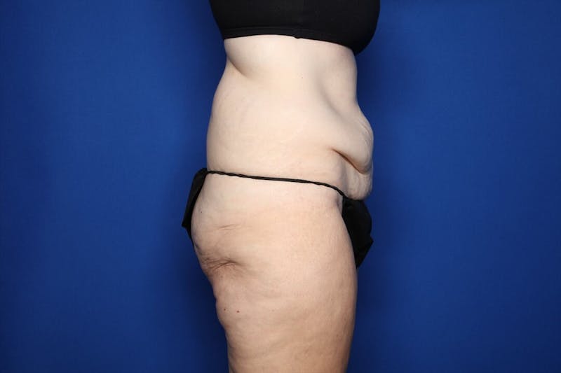 Tummy Tuck Before & After Gallery - Patient 236852 - Image 3