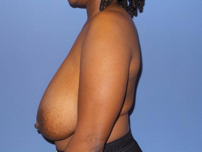 Breast Reduction Before & After Gallery - Patient 254654 - Image 3