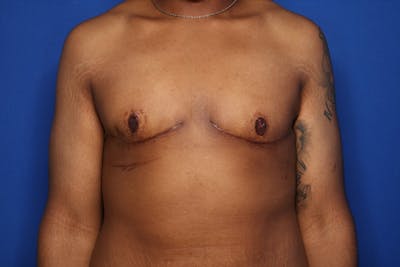 Gynecomastia (Male Breast Reduction) Before & After Gallery - Patient 207748 - Image 2