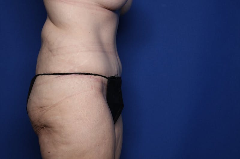Tummy Tuck Before & After Gallery - Patient 236852 - Image 4