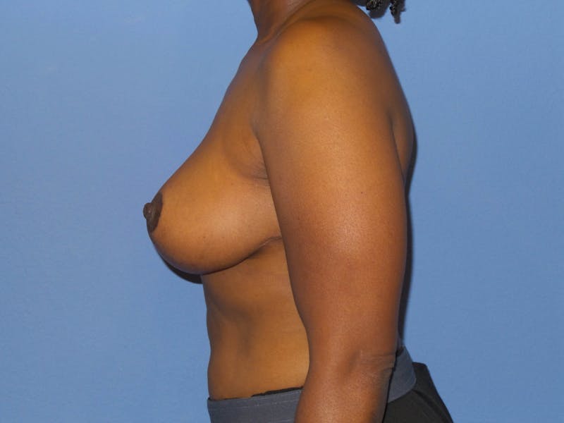 Breast Reduction Before & After Gallery - Patient 254654 - Image 4