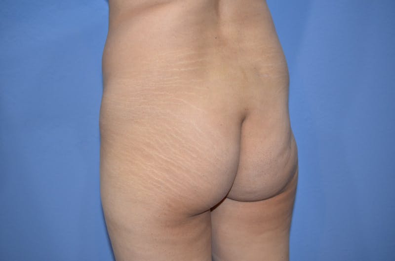Brazilian Butt Lift Before & After Gallery - Patient 330451 - Image 5