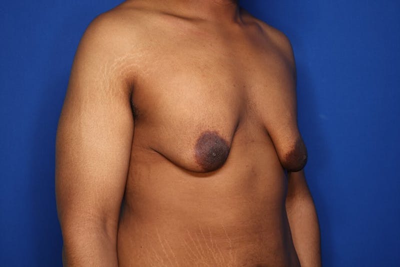 Gynecomastia (Male Breast Reduction) Before & After Gallery - Patient 207748 - Image 3