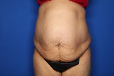 Tummy Tuck Before & After Gallery - Patient 719302 - Image 1