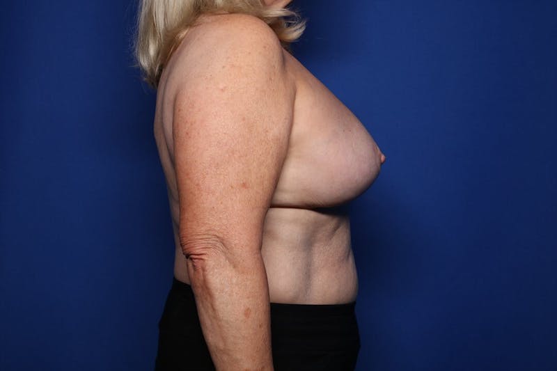Breast Revision Before & After Gallery - Patient 307933 - Image 4