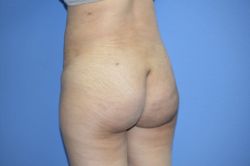 Brazilian Butt Lift Before & After Gallery - Patient 330451 - Image 4