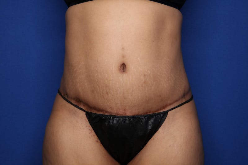 Tummy Tuck Before & After Gallery - Patient 719302 - Image 2