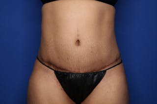 Tummy Tuck Before & After Gallery - Patient 719302 - Image 2