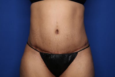 Tummy Tuck Before & After Gallery - Patient 719302 - Image 2