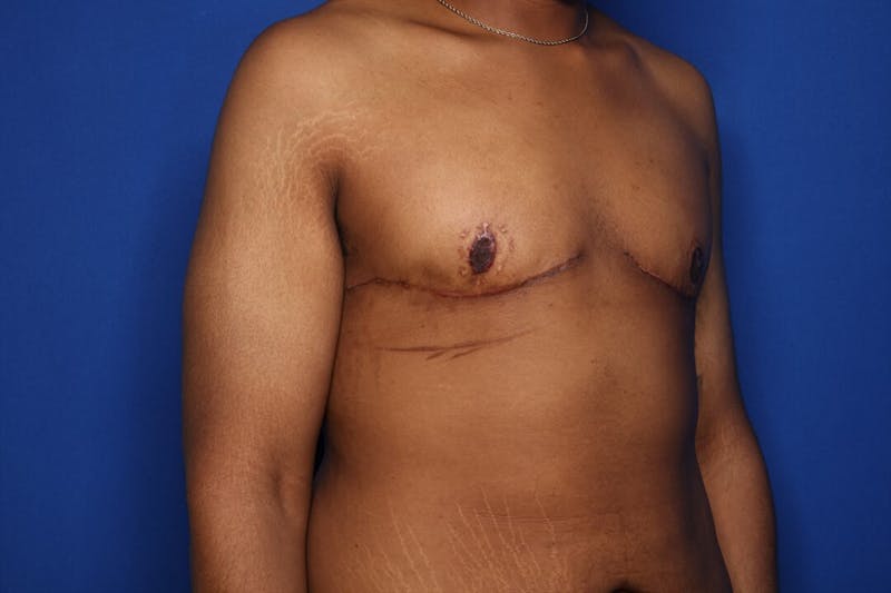 Gynecomastia (Male Breast Reduction) Before & After Gallery - Patient 207748 - Image 4